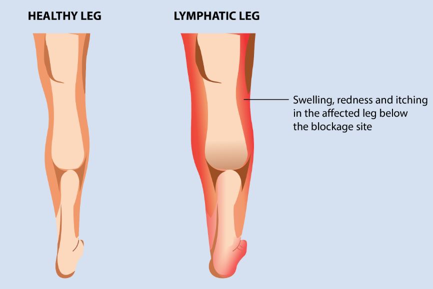 Lymphedema example
