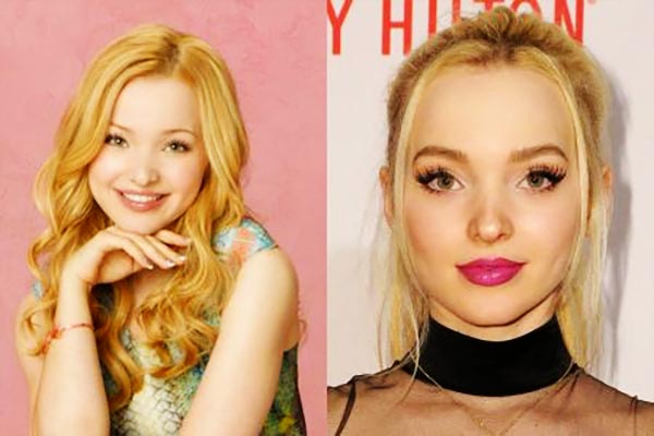 Dove Cameron's lip fillers and Botox