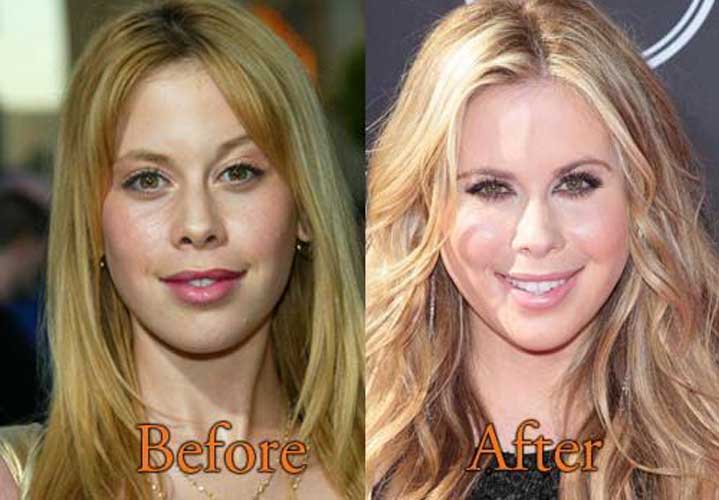 Tara Lipinski before and after plastic surgery
