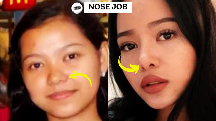 Bella Poarch's nose job