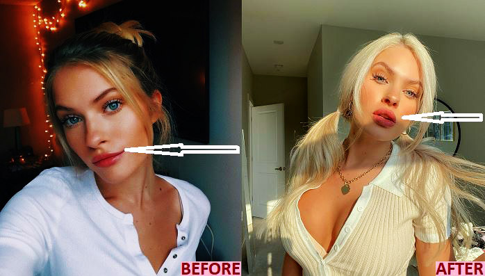 Claudia Walsh had her lip filled in 2019