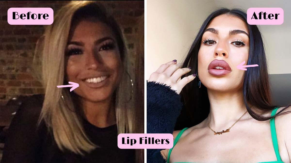 Emily Faye Miller before and after lip fillers