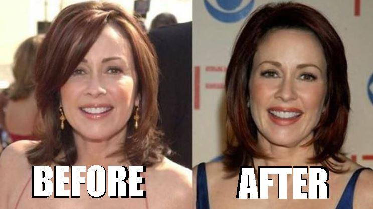 Patricia Heaton before and after plastic surgery