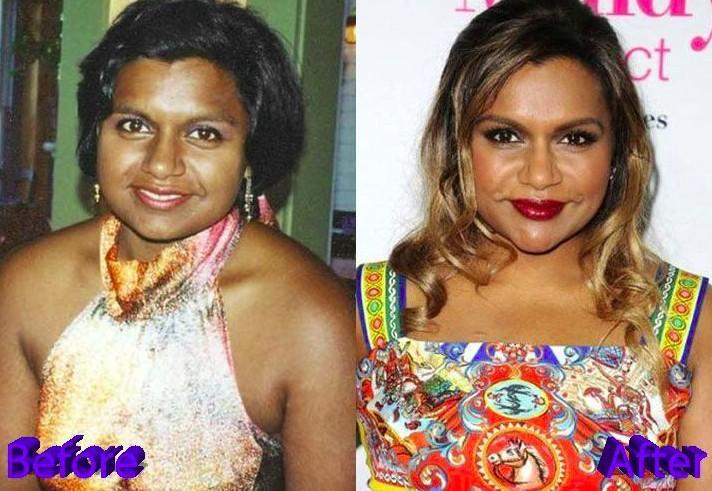 Mindy before and after lip injections