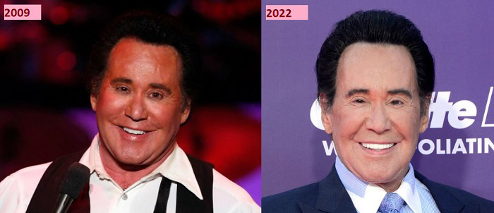 Wayne before and after plastic surgery